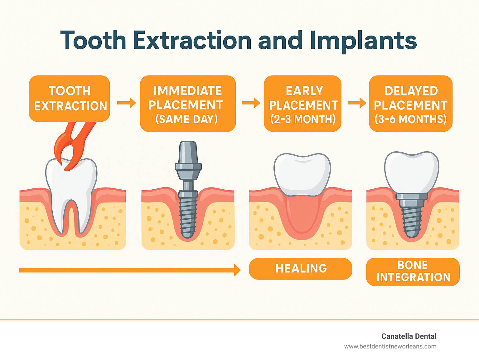 Tooth extraction and implants infographic Infographic showing the complete timeline from tooth extraction through implant placement, including immediate placement (same day), early placement (2-3 months), and delayed placement (3-6 months), with healing milestones and bone integration phases clearly marked - Tooth extraction and implants infographic