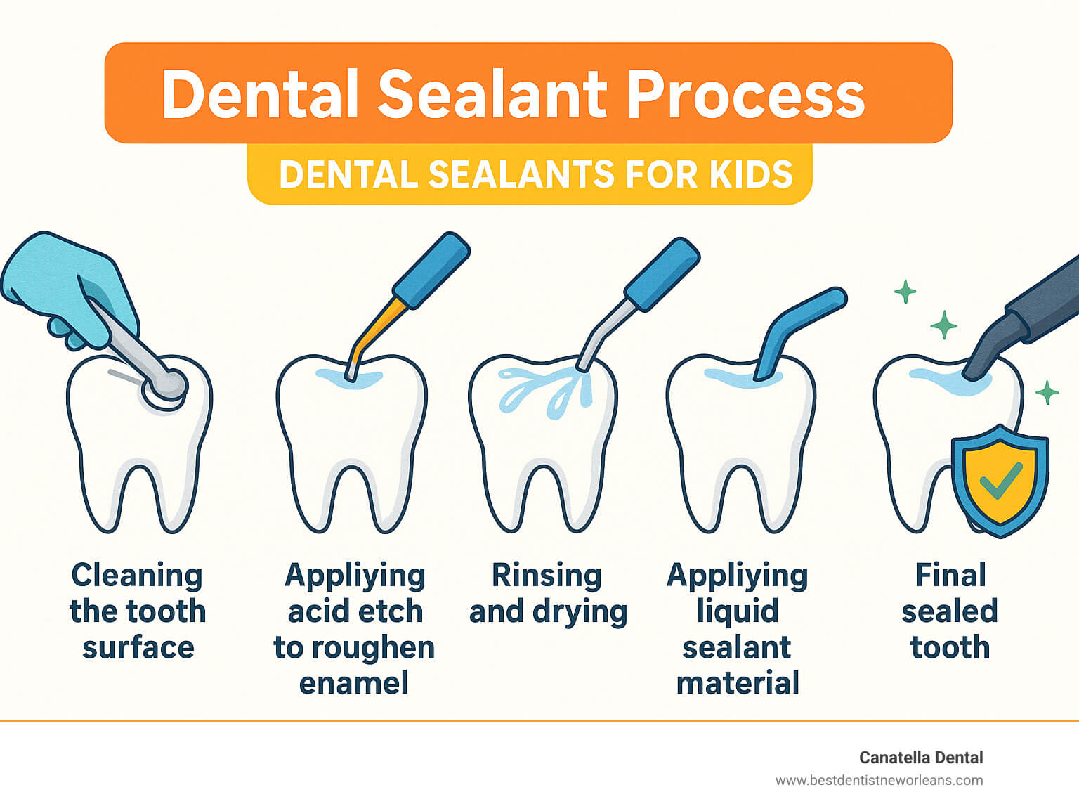 Dental sealant process showing: 1) Cleaning the tooth surface 2) Applying acid etch to roughen enamel 3) Rinsing and drying 4) Applying liquid sealant material 5) Curing with special light 6) Final sealed tooth with protective barrier against bacteria and food particles - dental sealants for kids infographic Dental sealant process