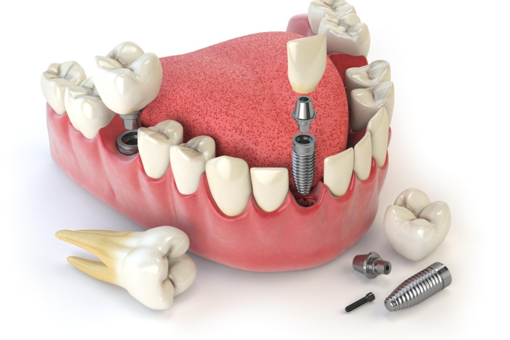 5 Advantages Of Dental Implants In Lakeshore, LA